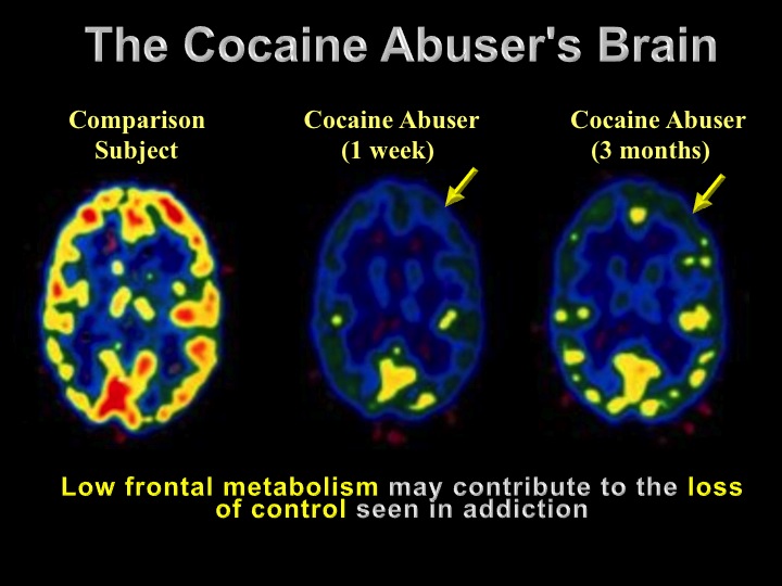 addicted to cocaine
